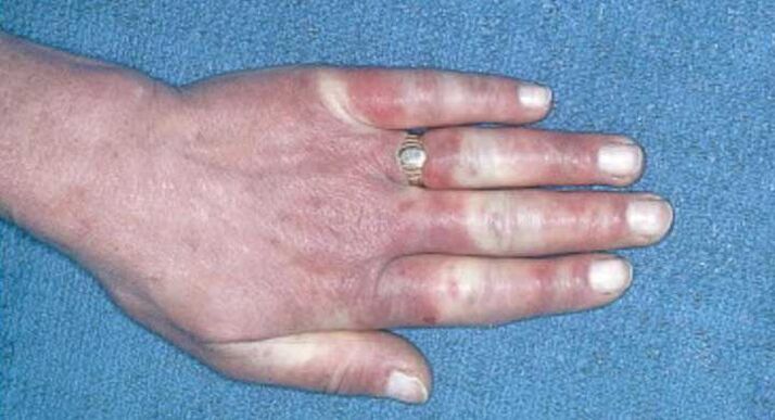 A Raynaud-szindróma klinikai képe - vasospasmus, hyperemia, ödéma