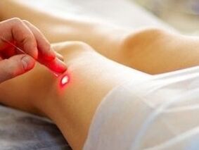 A térdízület arthrosis kezelése lézerrel